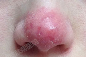 酒糟鼻症状